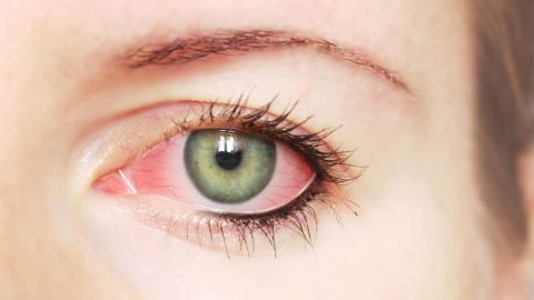 احمرار شديد في العين اليمنى (سبب احمرار العين وعلاجه )