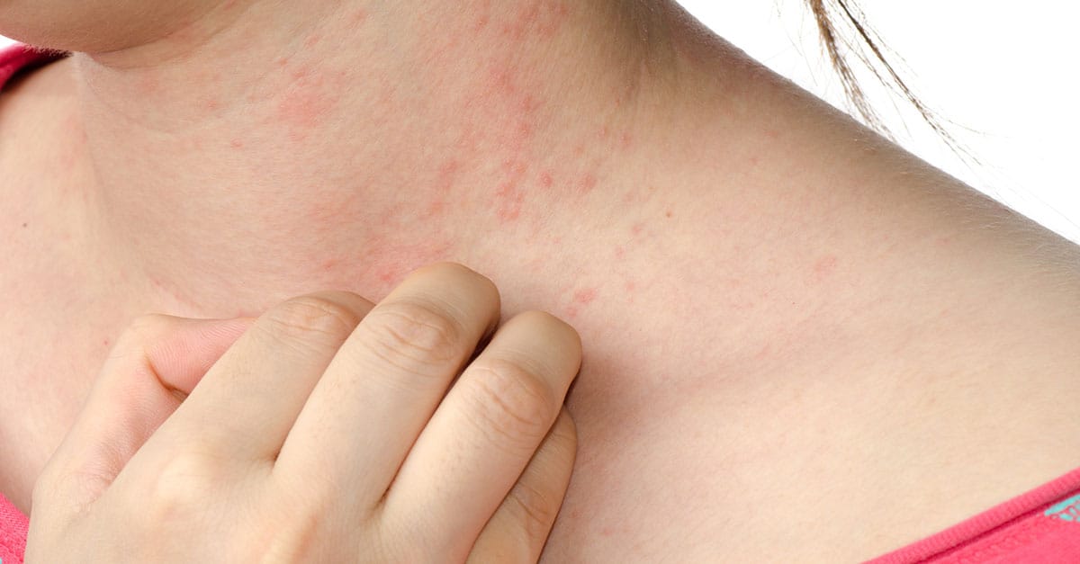 حساسية الجلد – الأعراض والأسباب والعلاج