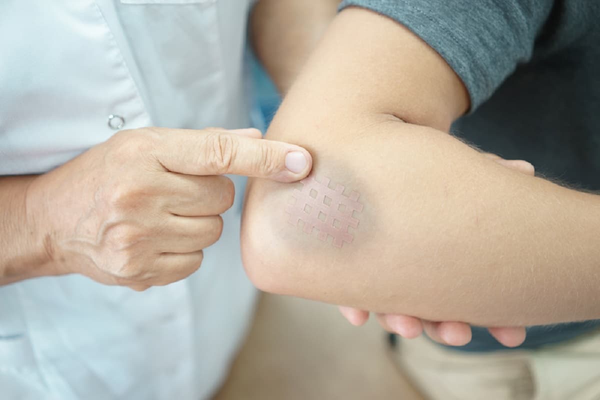 كيف اتخلص من الكدمات والازرقاق