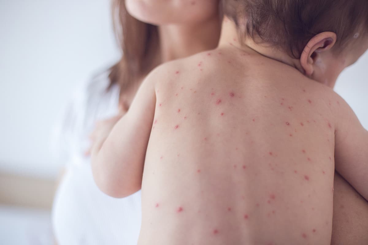 أعراض مرض الروبيلا وعلاجها