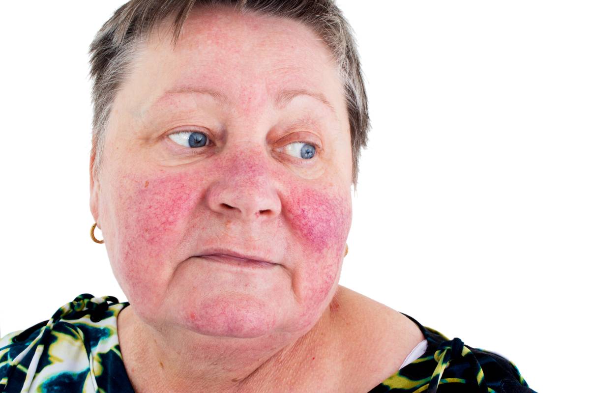 تشخيص طفح جلدي مع الام مفاصل