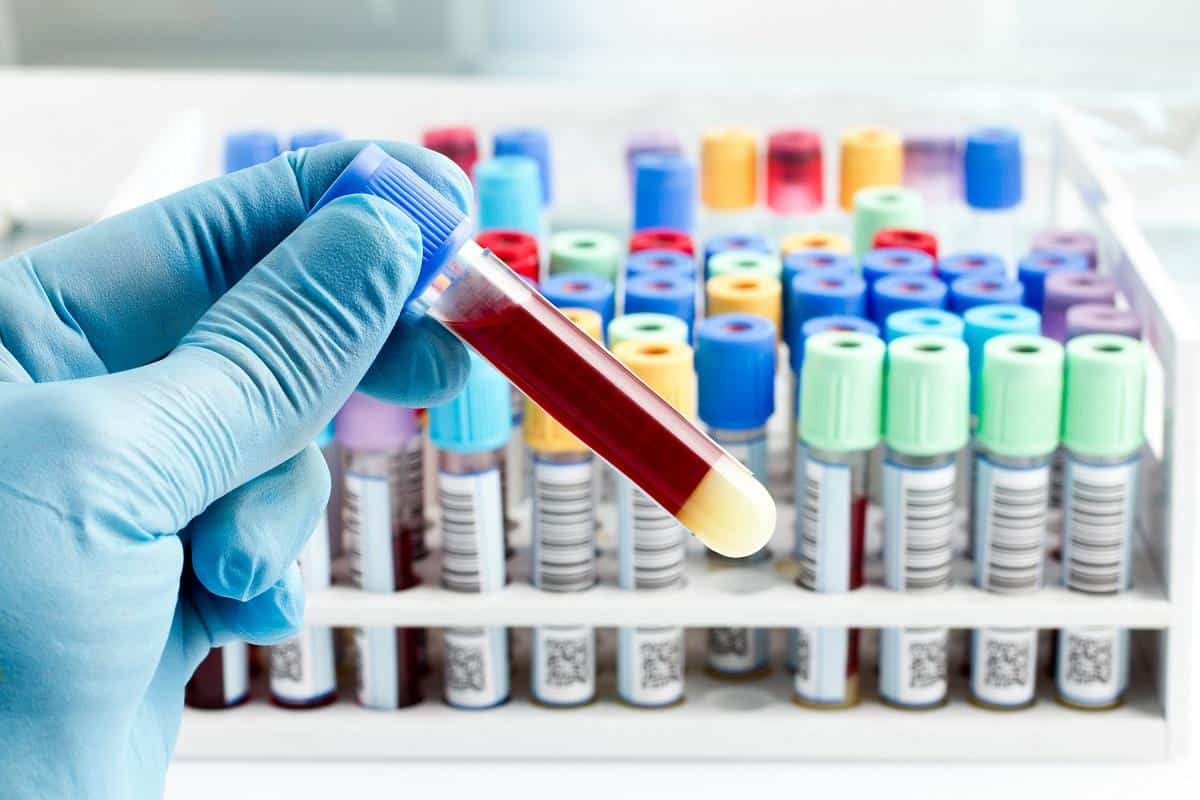 فوائد تحليل crp والامراض التي يكتشفها