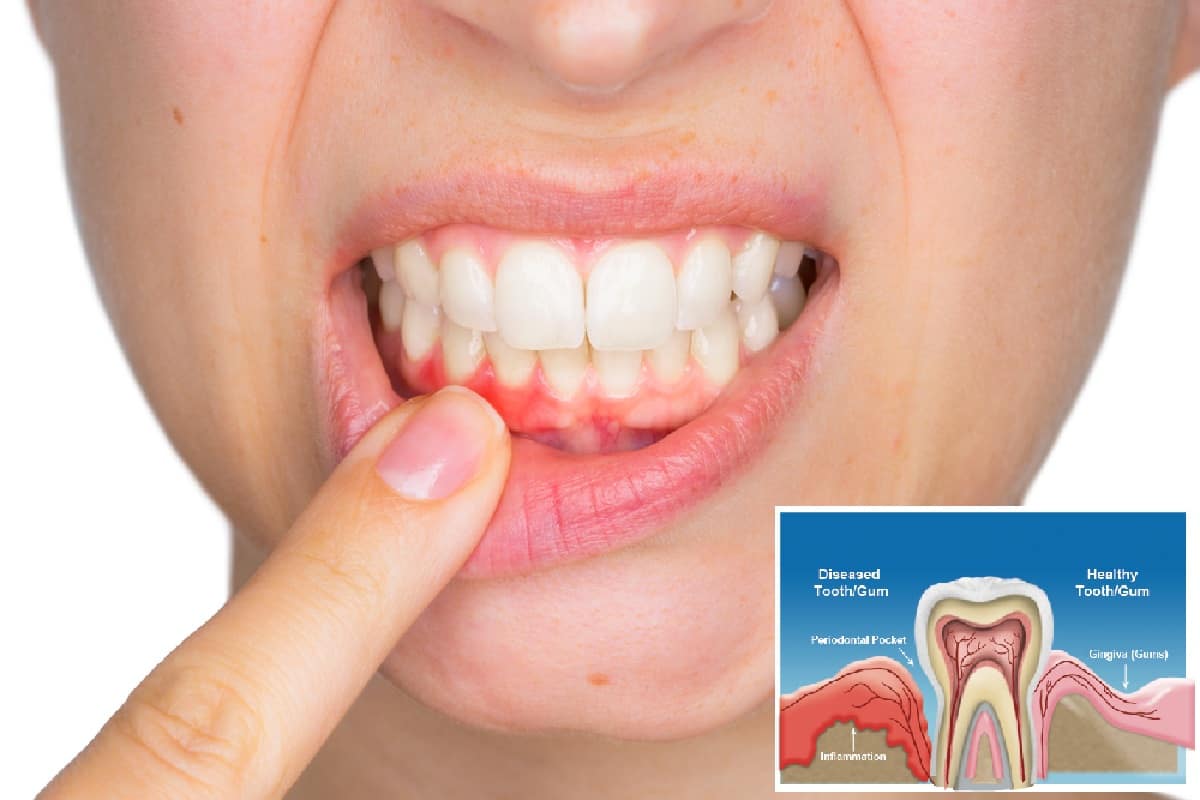 كيفية علاج التهاب اللثة المزمن