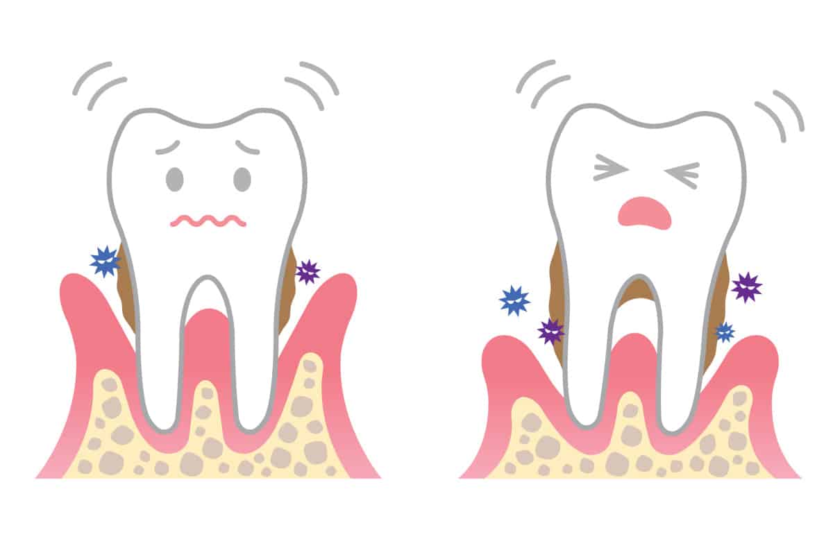 طريقة علاج التهاب اللثه بالمره