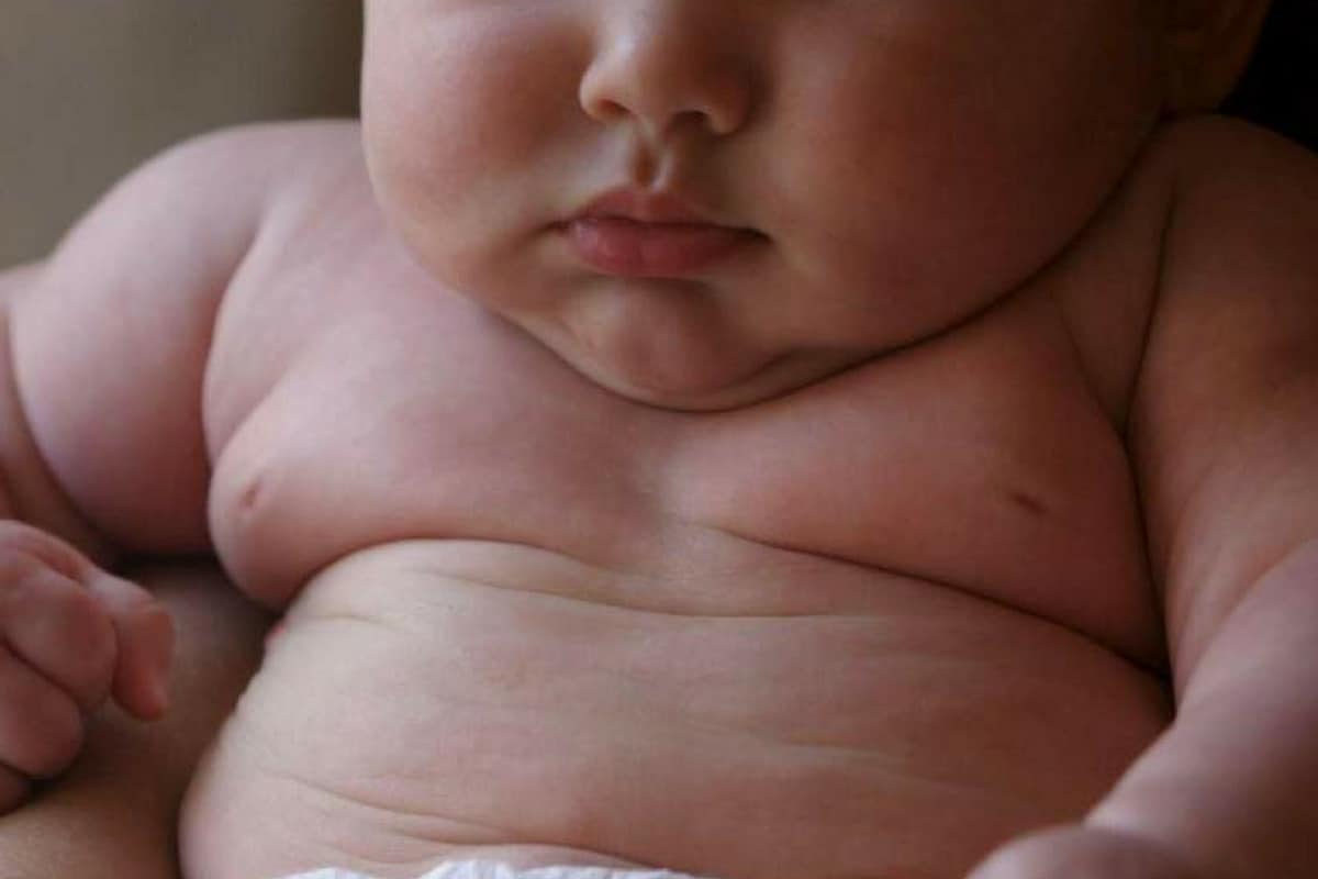 معلومات عن متلازمة برادر ويلي prader willi syndrome