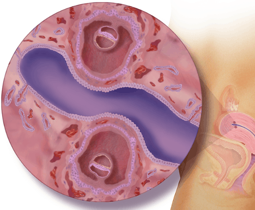 الأسبوع الرابع للتوأم داخل الرحم الأسبوع الرابع للتوأم داخل الرحم
