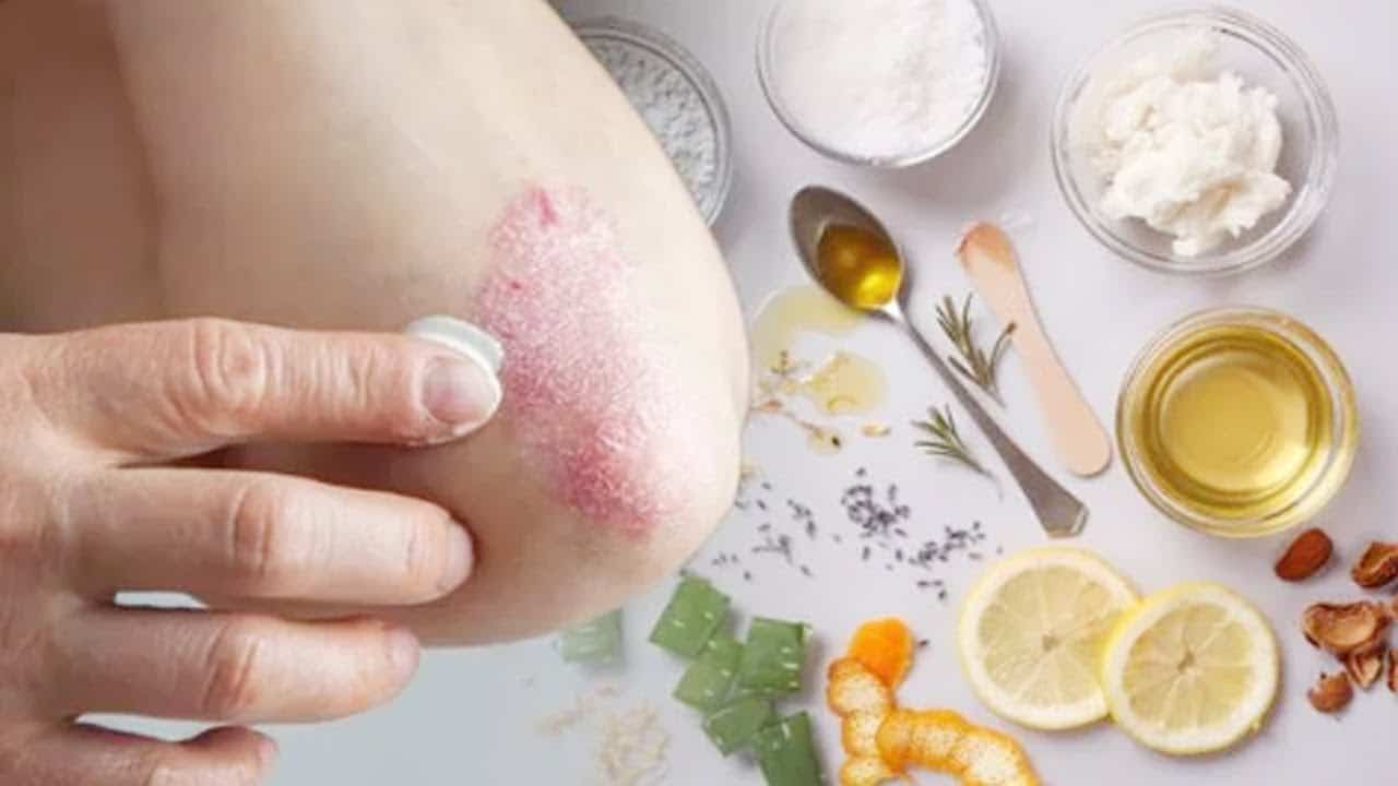 طرق مكافحة الاكزيما نهائياً