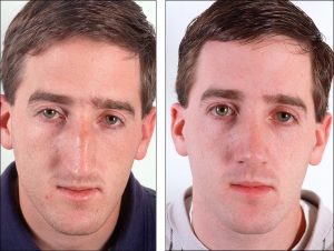 كيفية تصغير الانف للرجال كيفية تصغير الانف للرجال