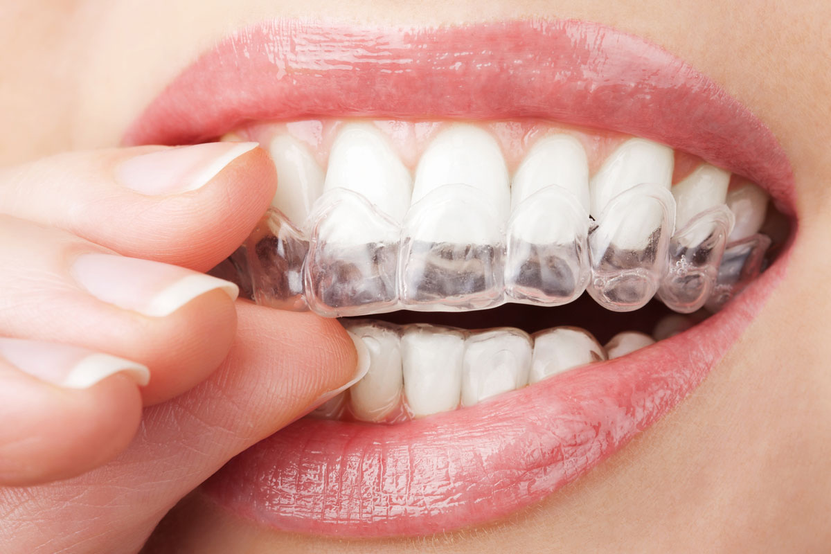 تجربتي مع تقويم الاسنان الشفاف