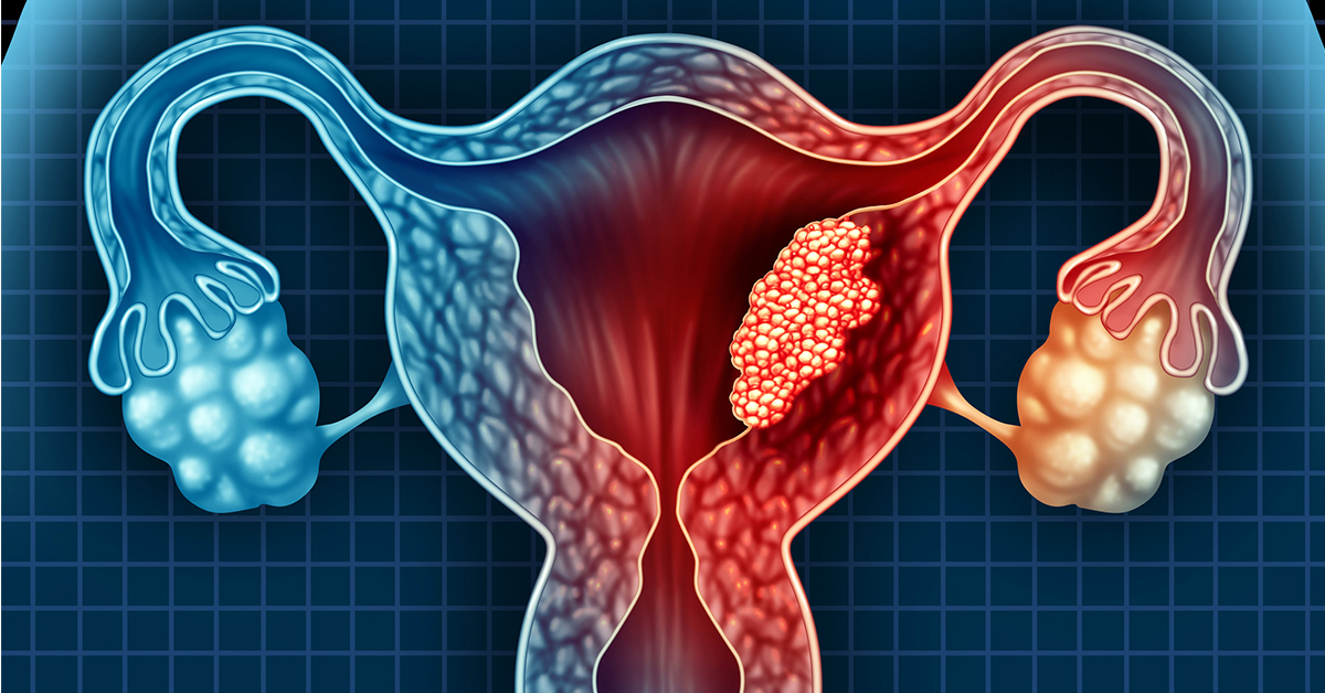 هل يمكن حدوث الحمل مع وجود التهاب في بطانة الرحم