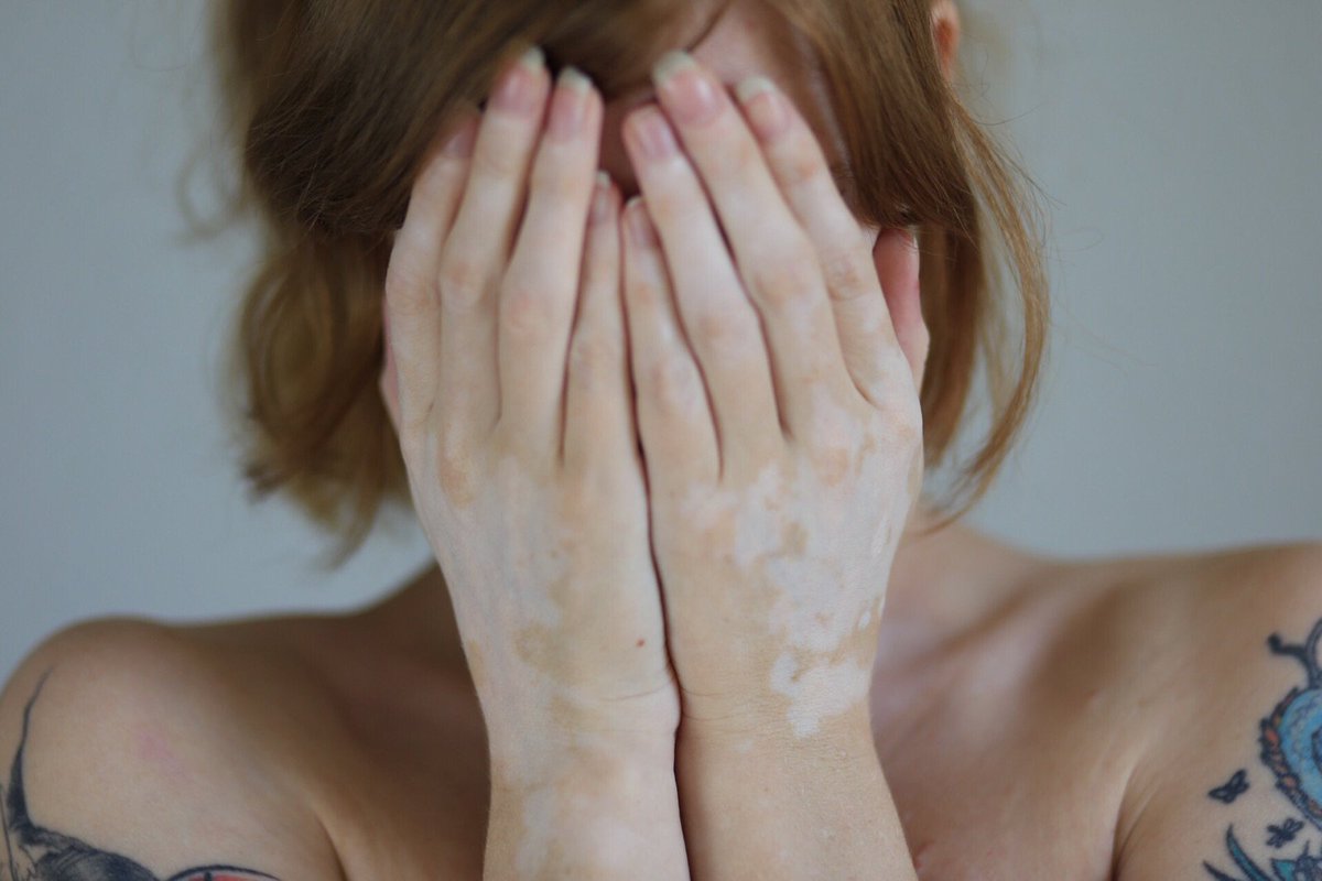 معلومات عن الميلانين وطرق زيادته بالجسم