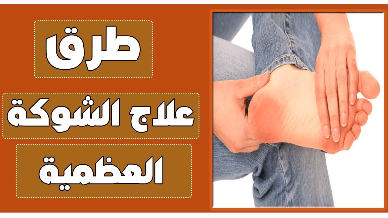طرق علاج الشوكة العظمية بالكعب بالاعشاب