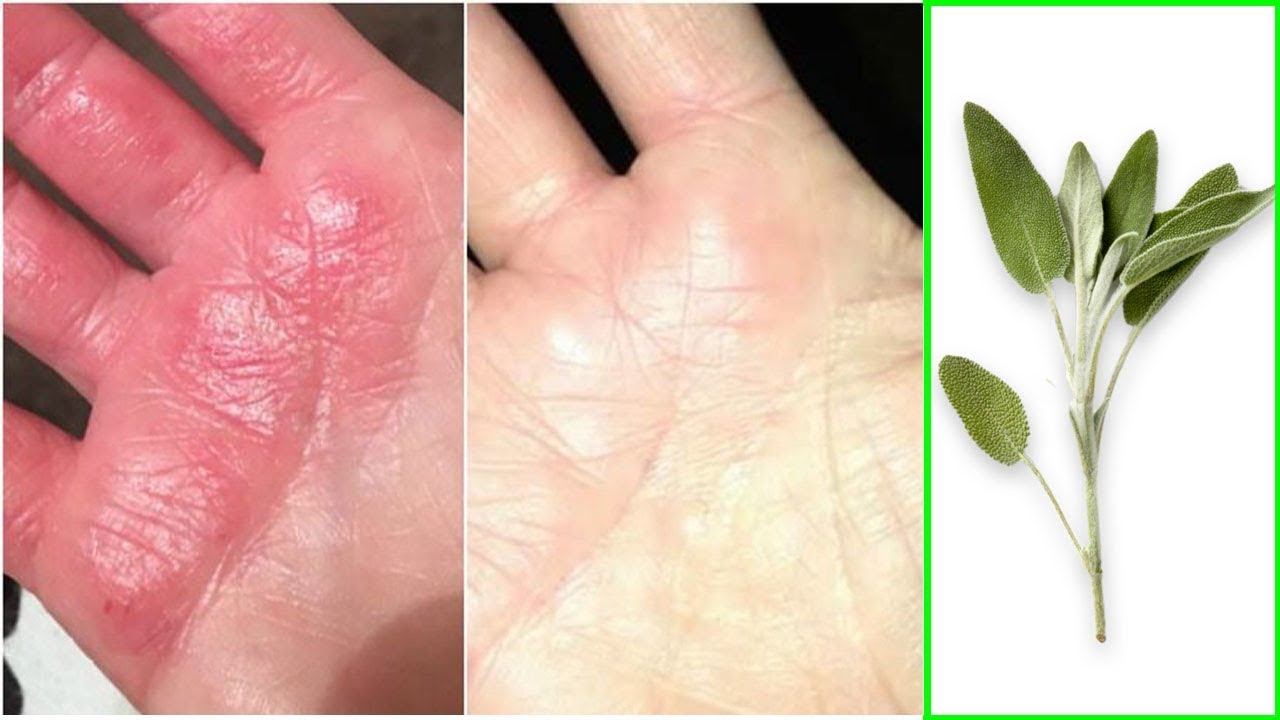 علاج الاكزيما في اليد طبيعيا