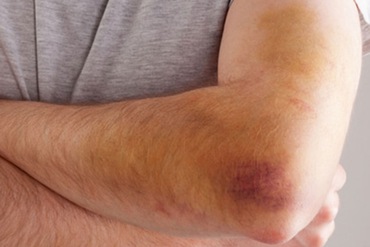 كيفية علاج الكدمات بالماء الساخن