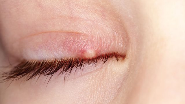 أعراض شعيرة العين وعلاجها