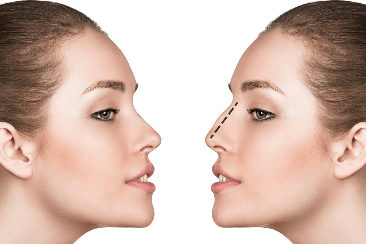 كل ما تحتاج لمعرفته عن إعادة تشكيل الأنف في دبي