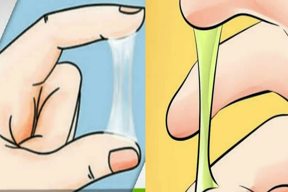 سبب نزول افرازات مهبلية بيضاء متجبنة وعلاجها مجرب