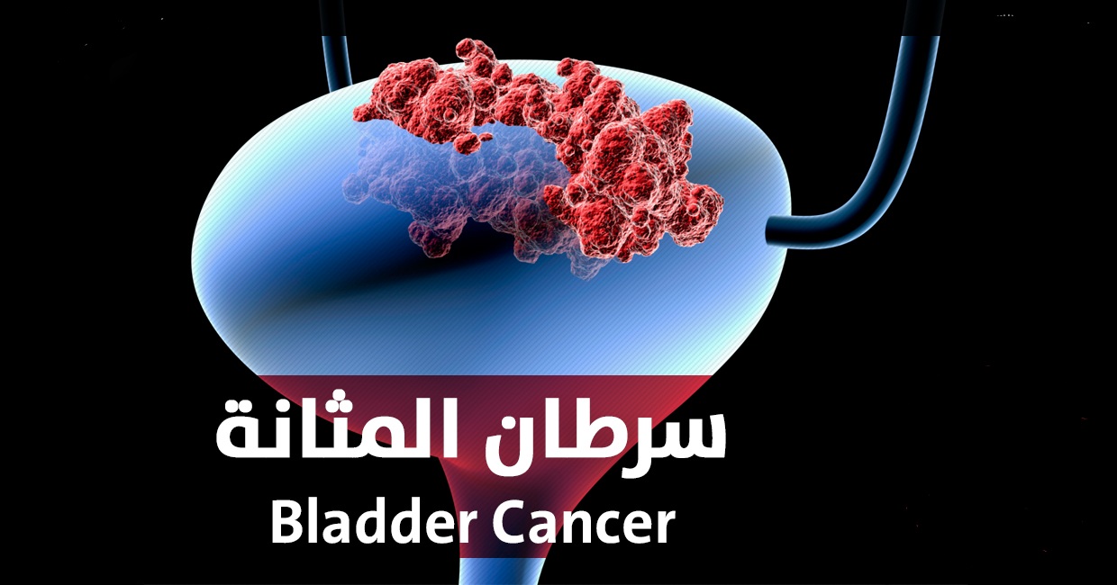 كيفية علاج سرطان المثانة بالاعشاب