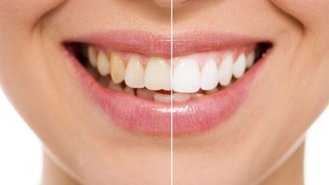 طريقة التخلص من اصفرار الاسنان