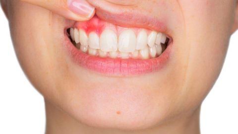 كيفية علاج خراج الأسنان بالاعشاب 11 عشبة فعاله لعلاج ألم والتهابات الأسنان