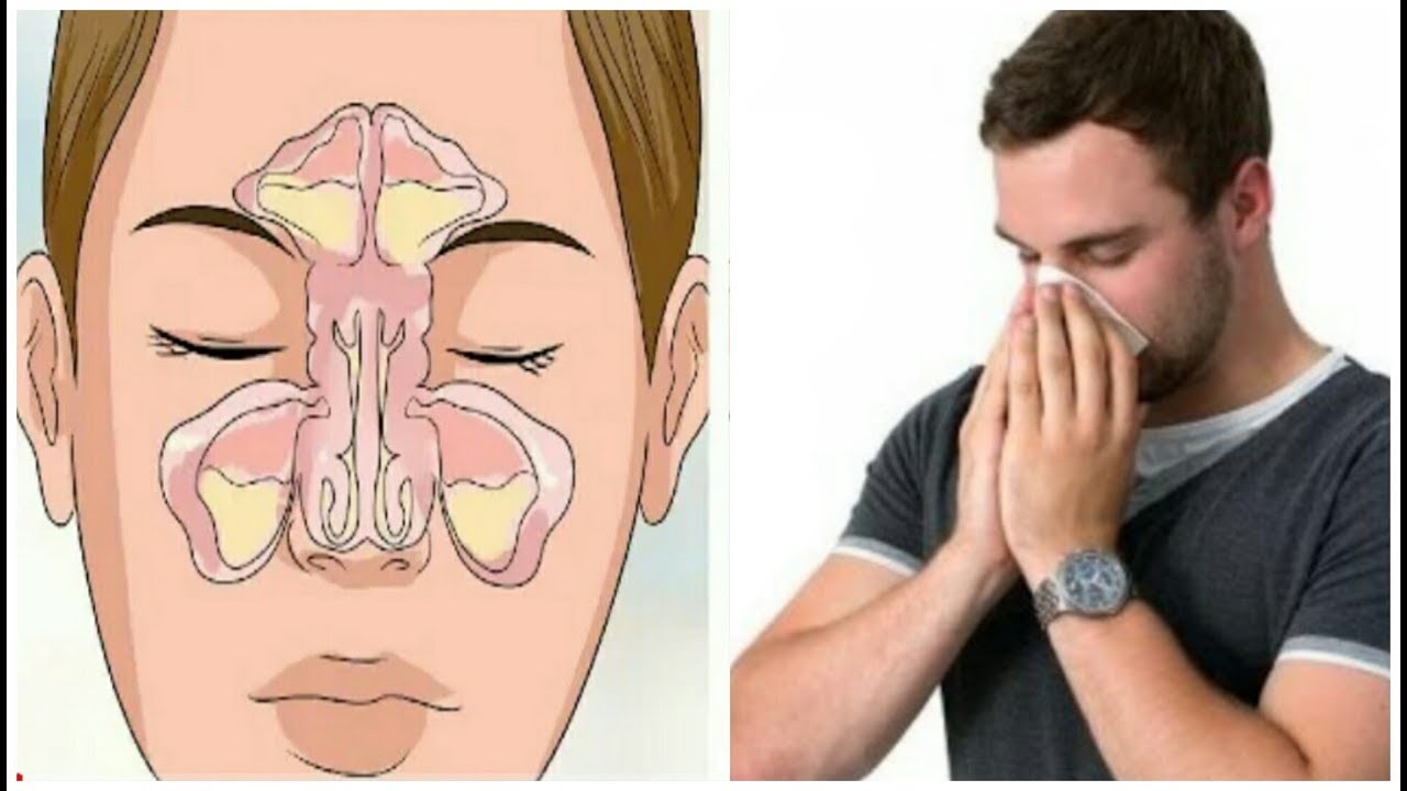 علاج حساسية الانف المزمنة بالاعشاب نهائيا وصفات مجربة