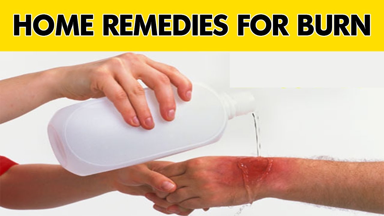 كيفية علاج الحروق في المنزل وأهم الإسعافات الأولية عند الإصابة بالحروق