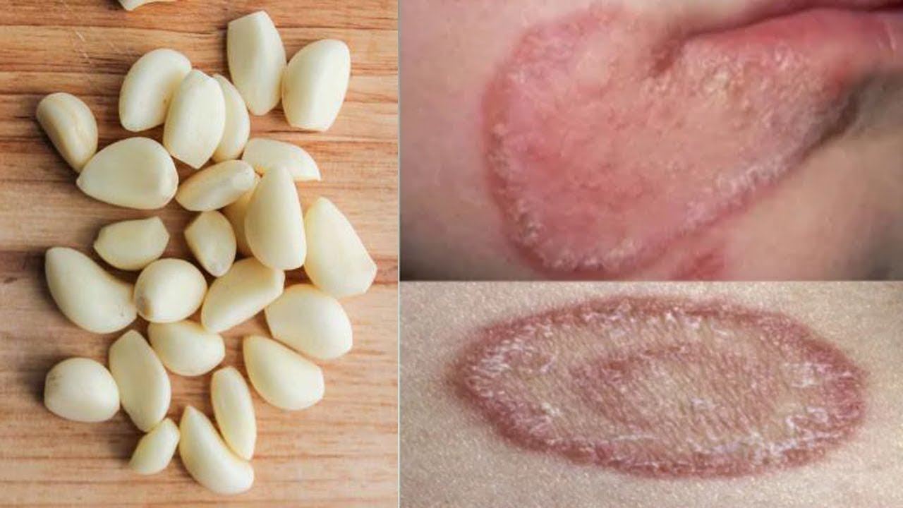 كيفية علاج فطريات الجلد بالثوم والأعشاب الطبيعية بسرعة