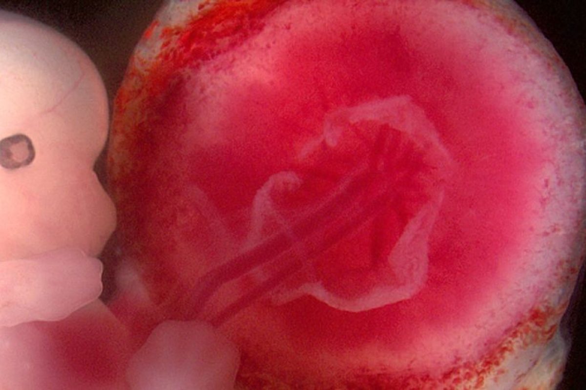 ما هي اسباب انفصال المشيمه وعلاماتها ..تجاربكم مع انفصال المشيمة وعلاجها