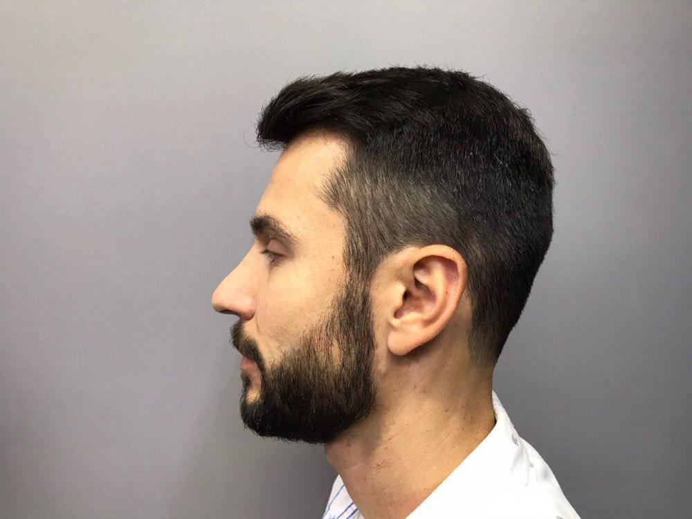 أسرع روشتة علاج ثعلبة اللحية .. كيفية علاج الثعلبة في الذقن 