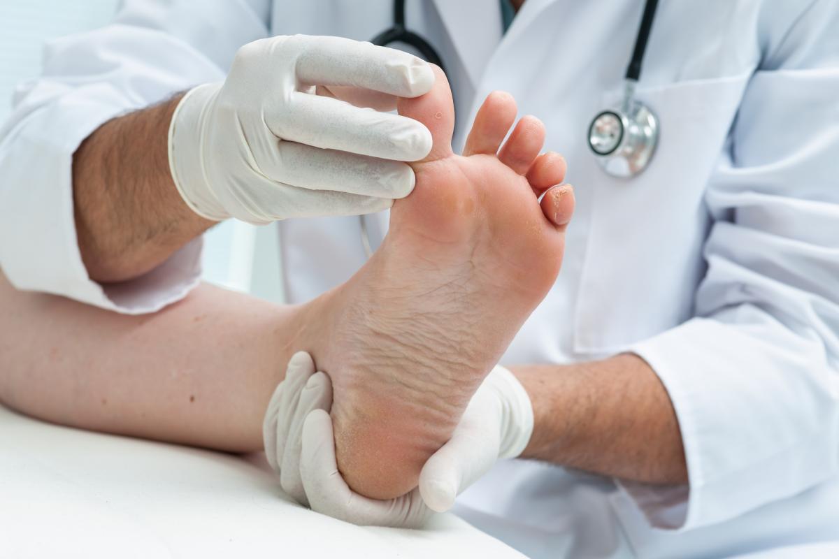 كيفية علاج ثالول القدم بالأعشاب والطب البديل وطبيا مجرب