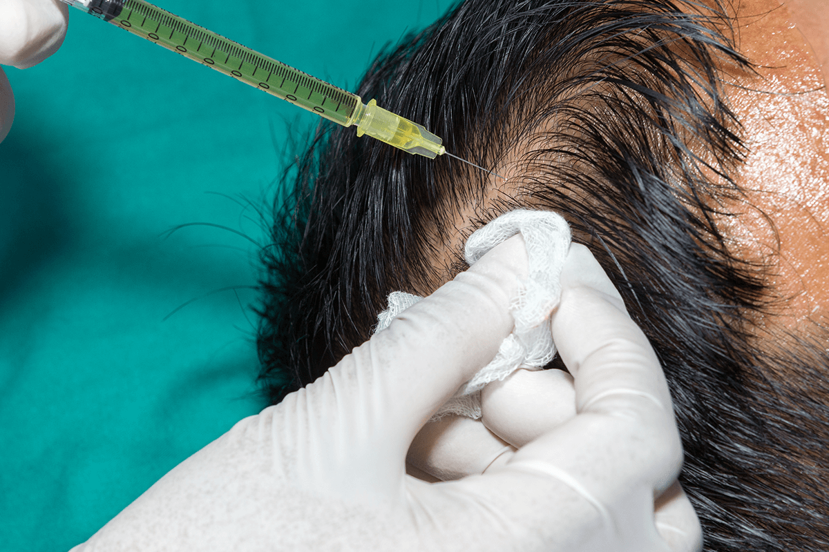 تجربتي مع زراعة الشعر في السعودية 2024 أفضل الأطباء والأسعار