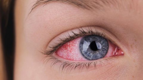 كيفية علاج رمد العين نهائيا وصفات طبيعية للرمد مجربة سريعة المفعول