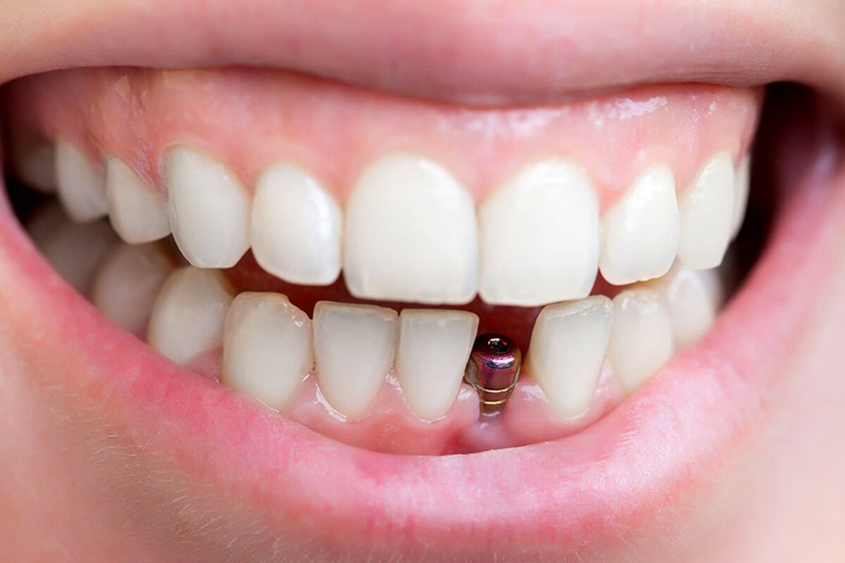 تفسير حلم سقوط الأسنان السفلى لابن سيرين أدق التفسيرات