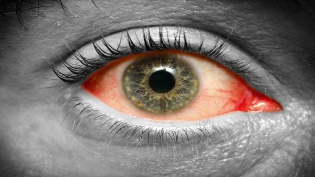 أعراض العين التراكمية .. العلامات الواضحة للحسد