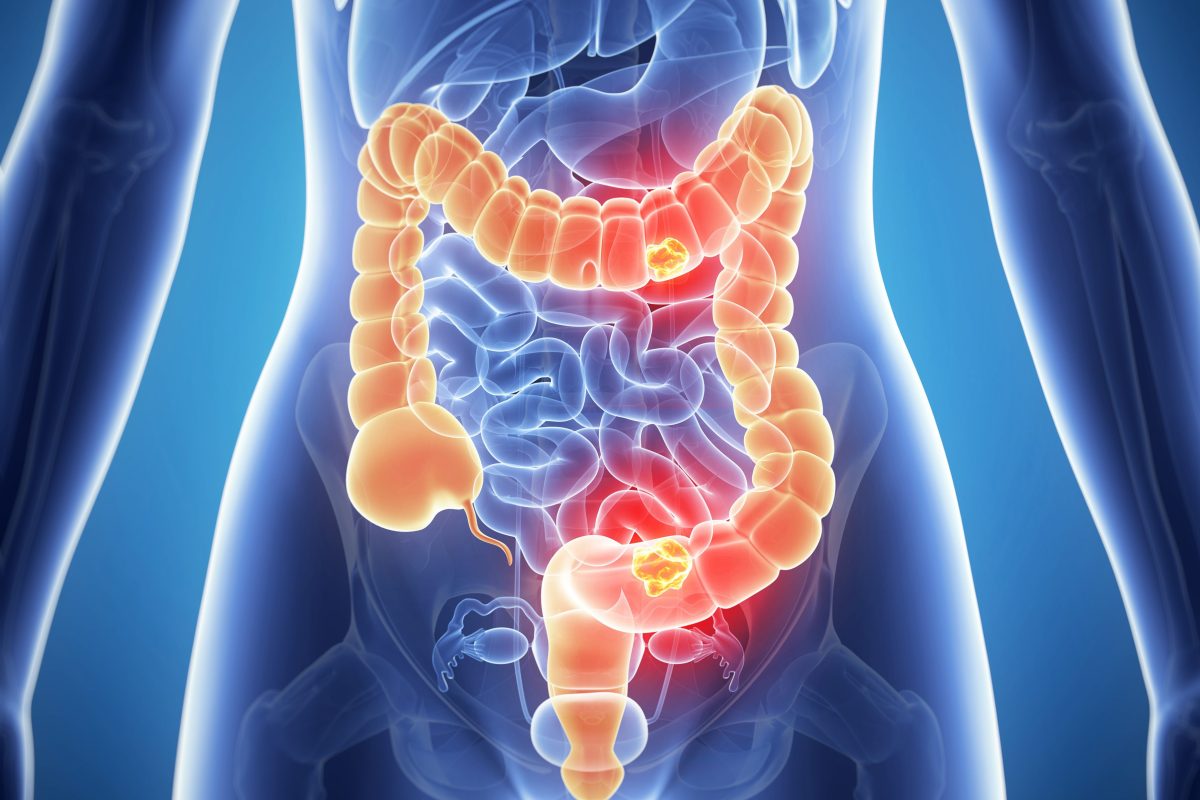 هل البواسير تسبب خروج مخاط