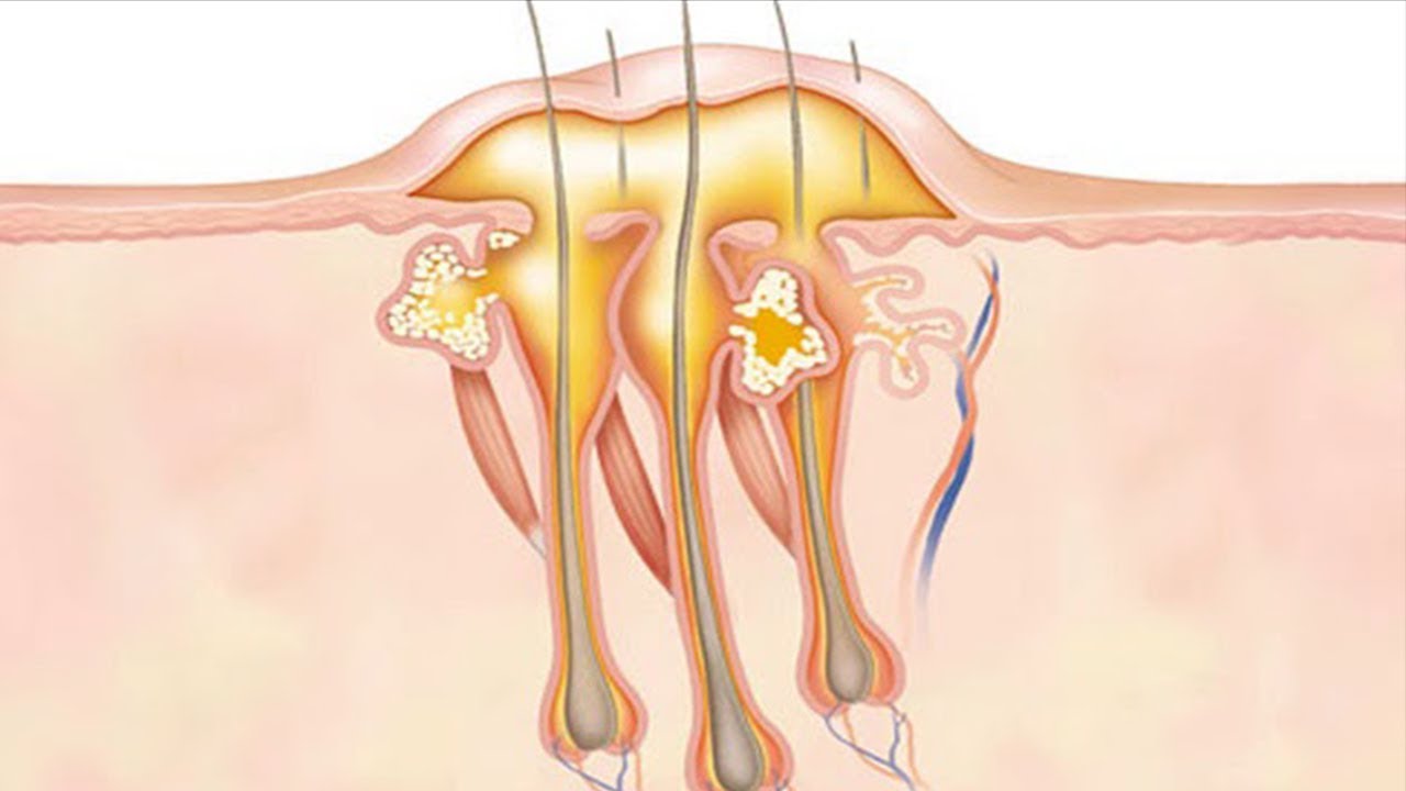خلطات علاج الدمامل في الطب النبوي