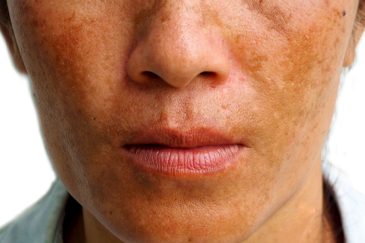 تجربتي في علاج الكلف في الوجه