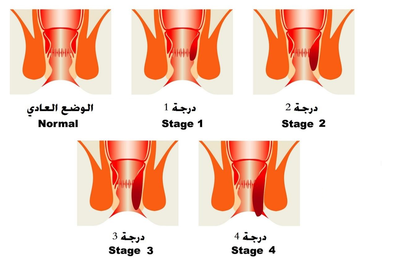 علاج البواسير بالفازلين