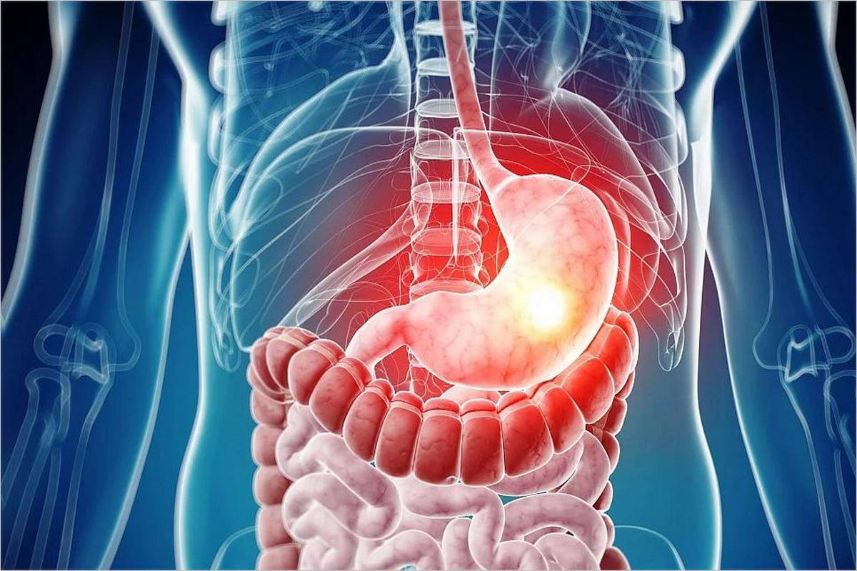 كم يستغرق علاج قرحة الاثني عشر