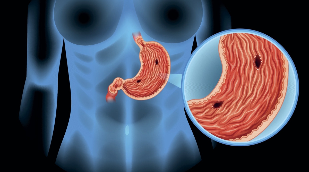تجربتي في علاج قرحة المعدة