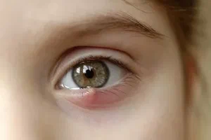 أسباب ظهور حبوب داخل جفن العين وعلاجها