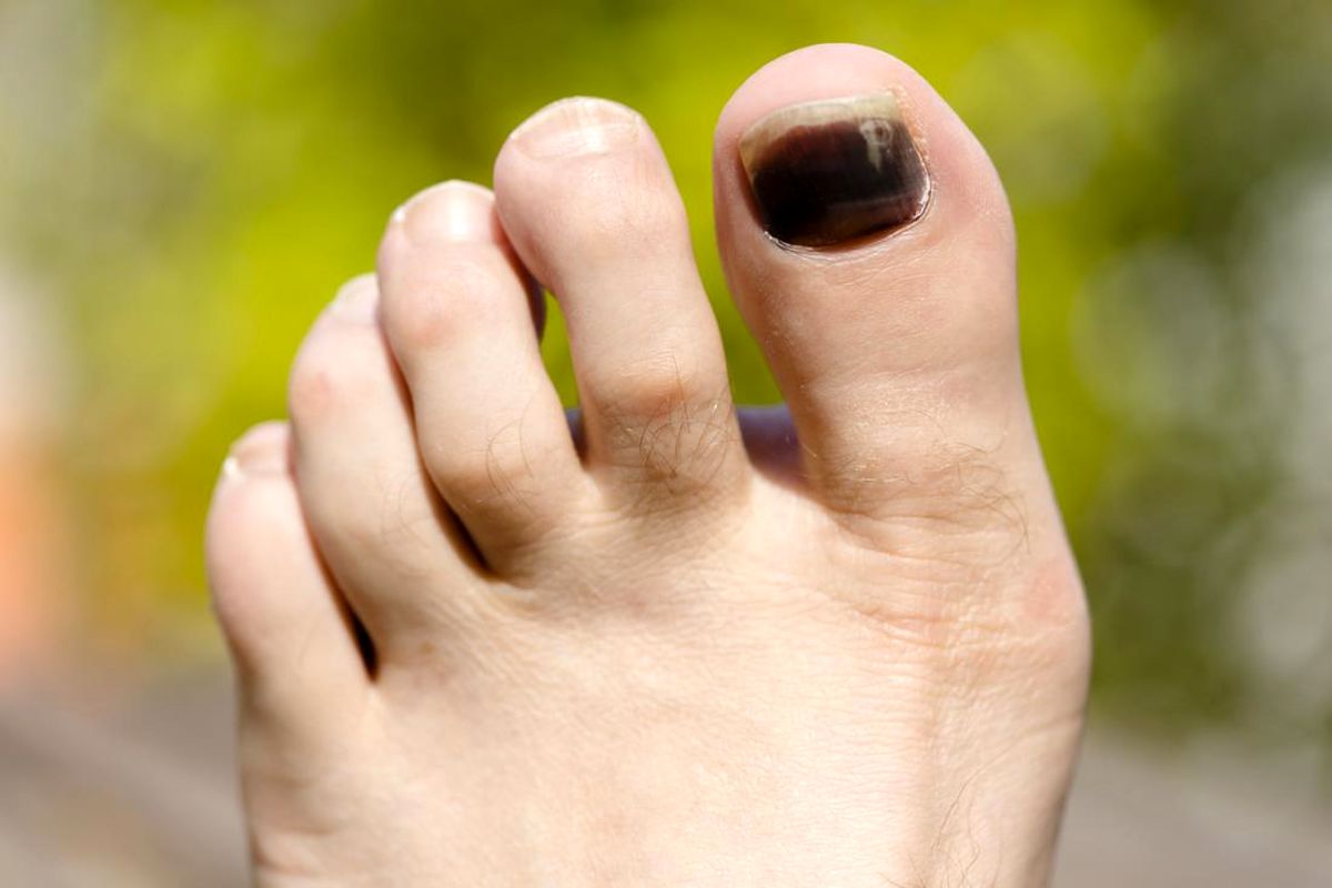أسباب ظهور خطوط سوداء رفيعة على الأظافر