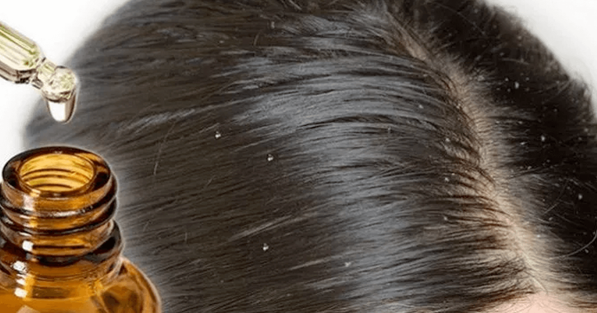 أسباب قشرة الشعر عند النساء وعلاجها