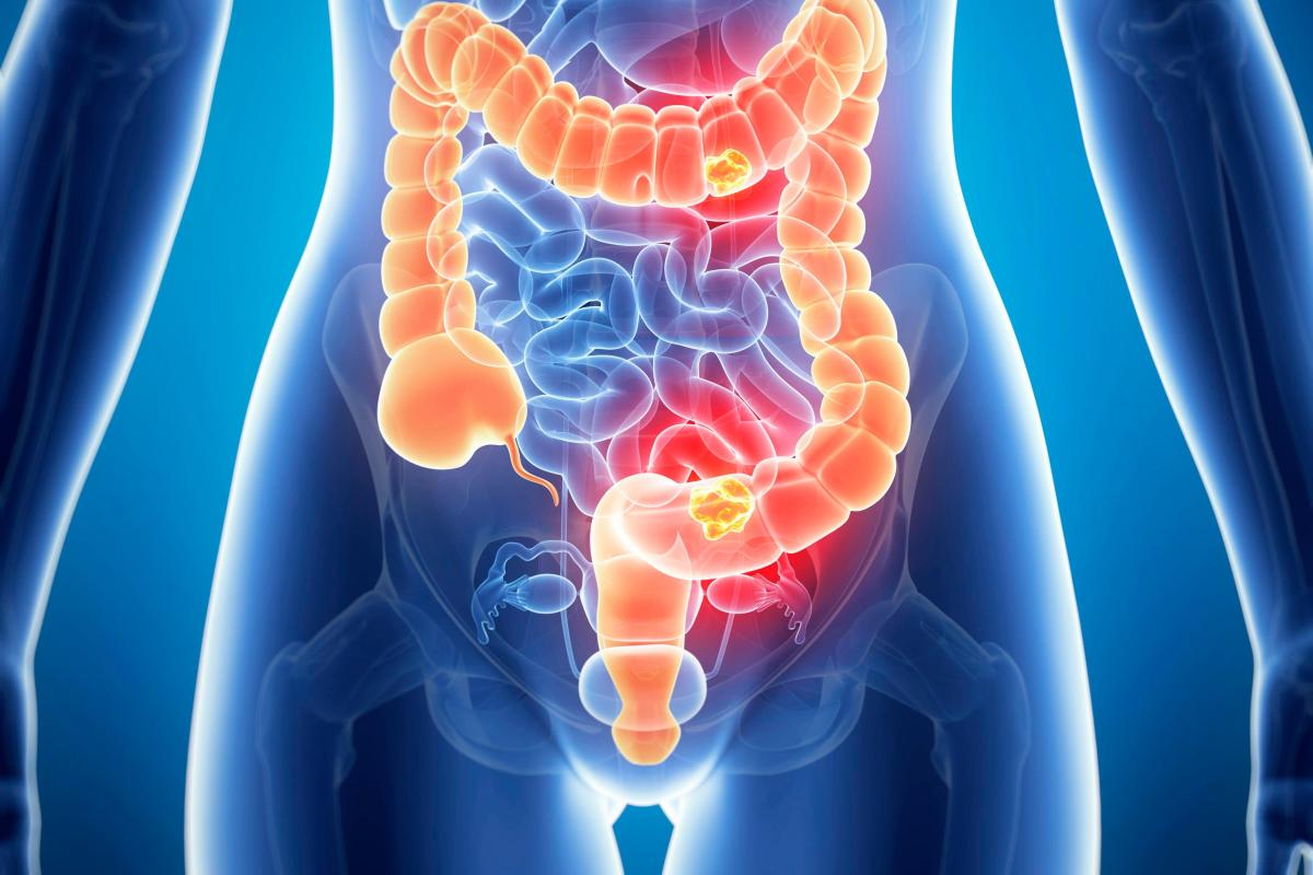 أعراض العصب الحائر بالقولون