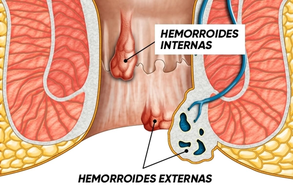 الفرق بين الناسور والبواسير