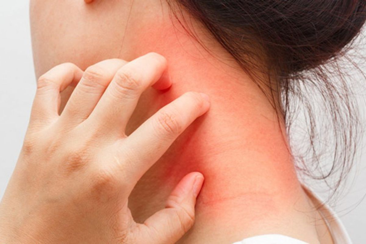 علاج حساسية الجلد والهرش في المنزل