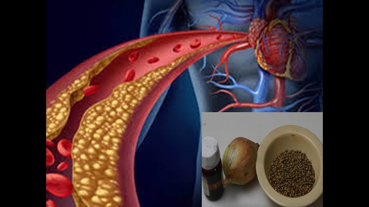 هل انسداد الشرايين خطير