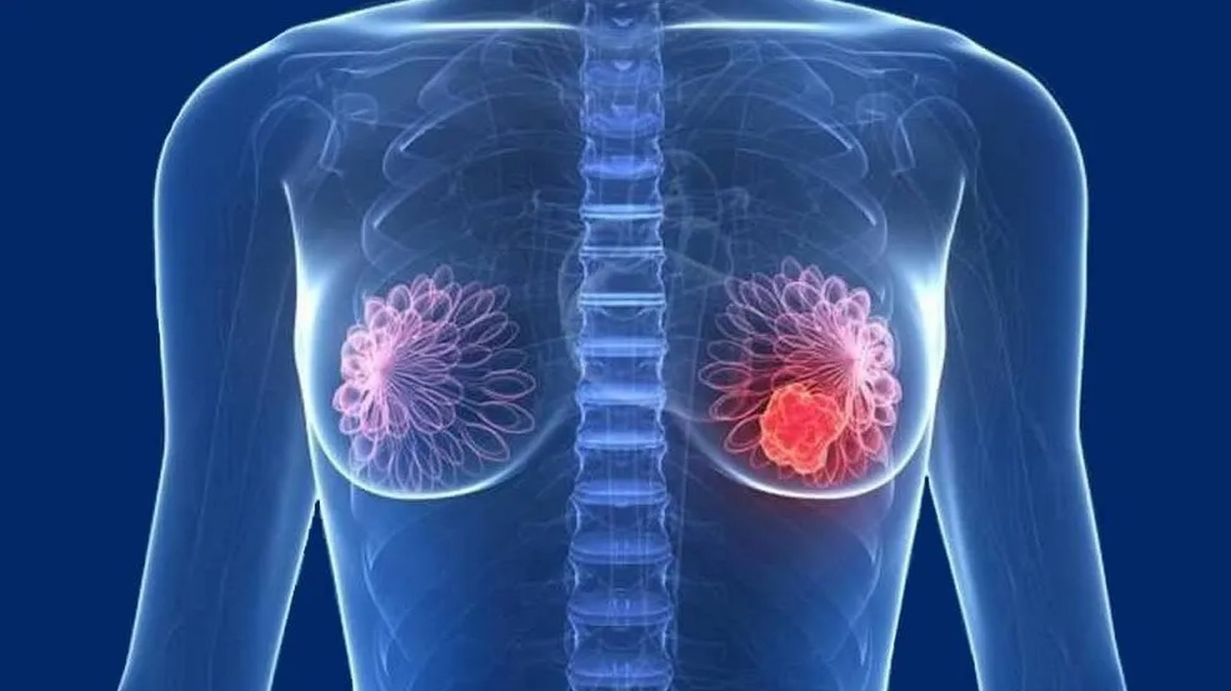 الفرق بين الغدد اللبنية والسرطان