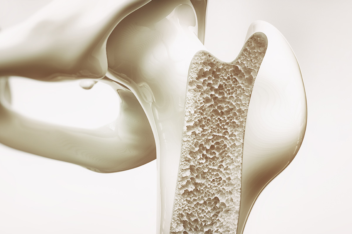 كيف أتخلص من هشاشة العظام