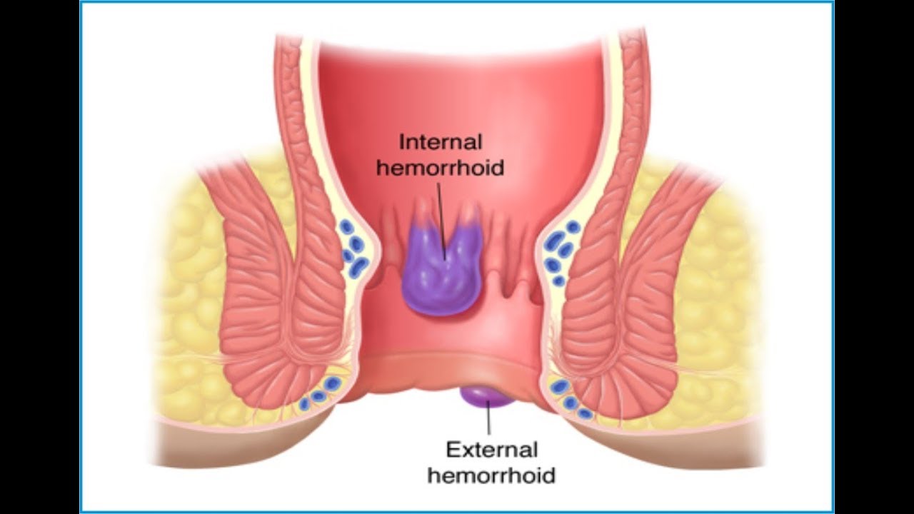 تجربتي مع عملية البواسير بالليزر ومدة الشفاء بعد العملية